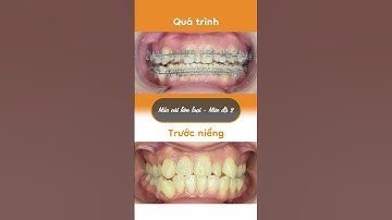 Hành trình LỘT XÁC nhờ niềng răng của Thùy Trang