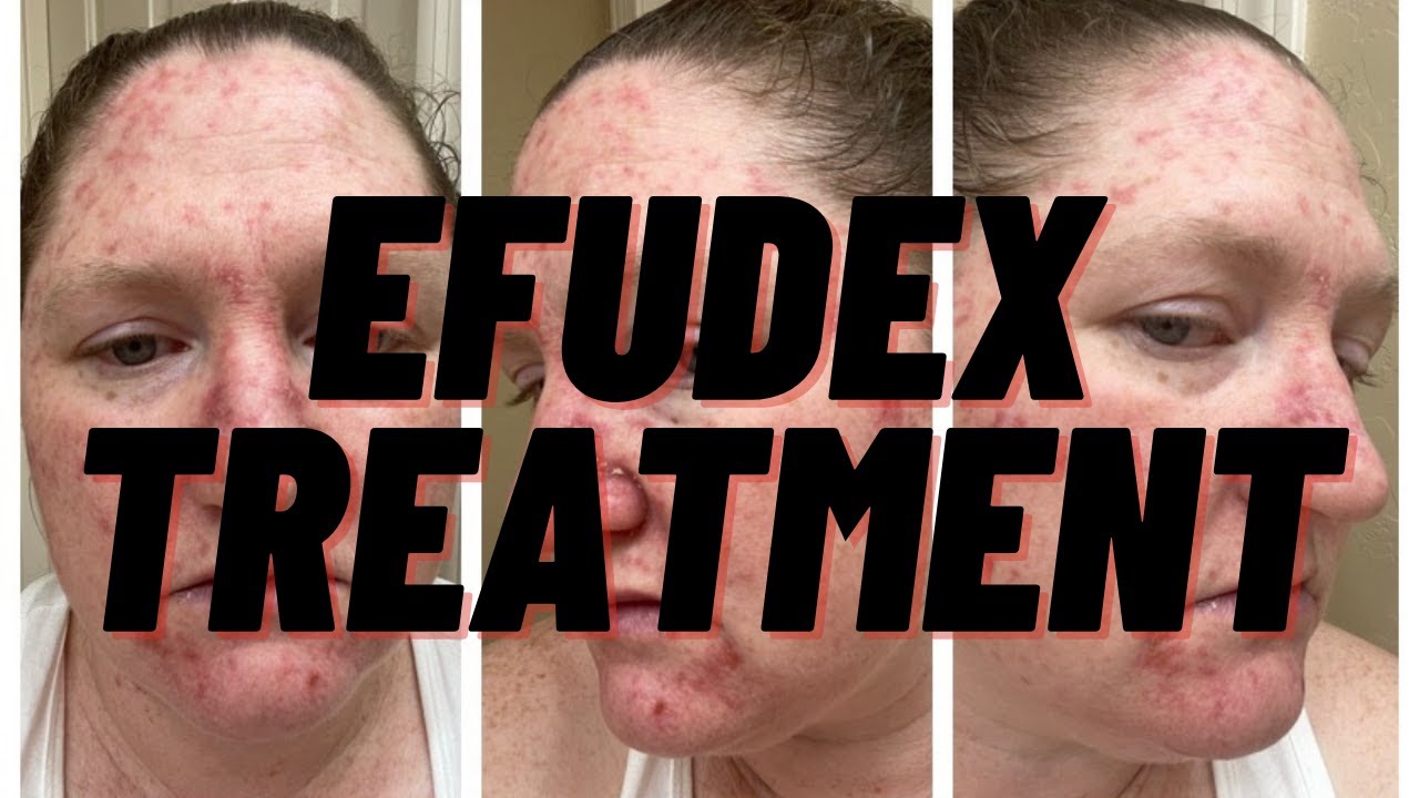 Showing You Every Day Of My Efudex Treatment Topical Chemotherapy Cream YouTube