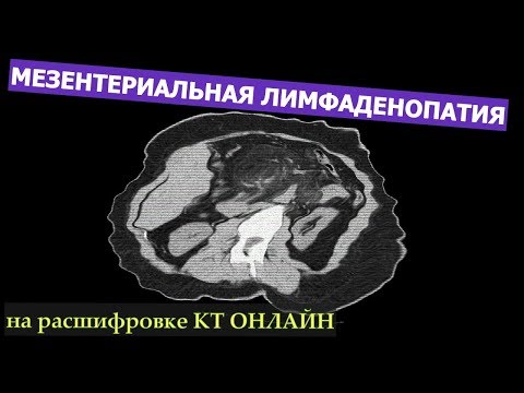 МЕЗЕНТЕРИАЛЬНАЯ ЛИМФАДЕНОПАТИЯ брюшной полости на расшифровке КТ через интернет