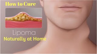 How to Treat Lipoma Without Surgery   How to Cure Lipoma   5 Ways to Get Rid of a Lipoma Naturally