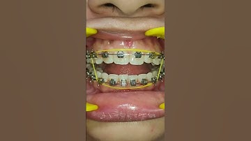 Box elastics to correct anterior openbite. #model #smile #beauty #fashion #ahmedabad #3m #braces #3d