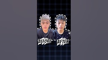 Kết thúc liệu trình 10b nắn chỉnh mặt lệch. #hungtrilieu #matlech #nanmat