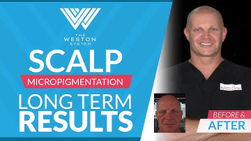 "Long-Term Outcomes of Scalp Micropigmentation: Before & After Comparisons"