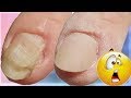 DEFORMIERTER Nagel durch VERLETZUNG??😱😱Rekonstruktion eines Nagels #nagelverletzung,