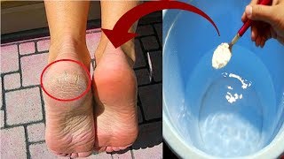 In Just 3 Minutes - Get Rid of CRACKED HEELS Permanently, Magical Cracked Heels Home Remedy