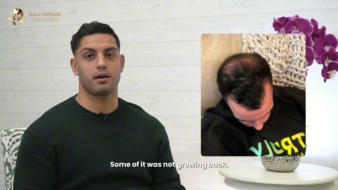 Hair Transplant Turkey Experience: Incredible Before/After Results at the Asli Tarcan Clinic
