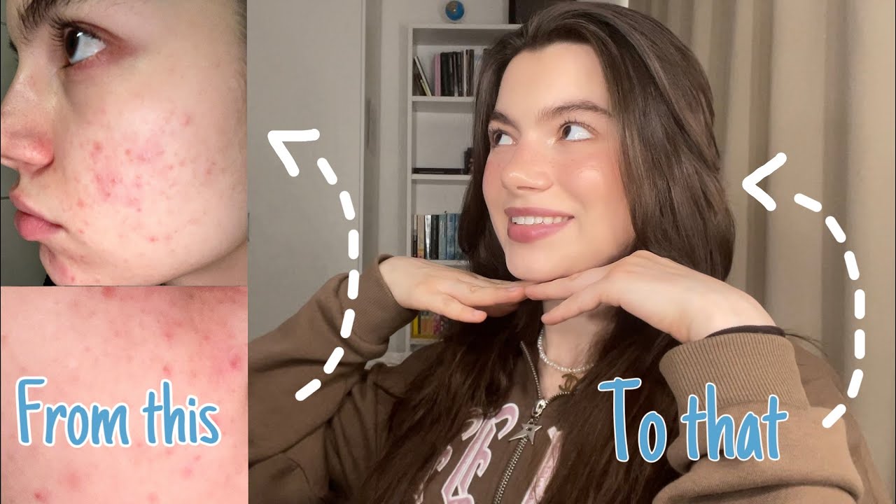 How I got rid of my Acne in 2 Weeks!! (My morning Skincare Routine ...