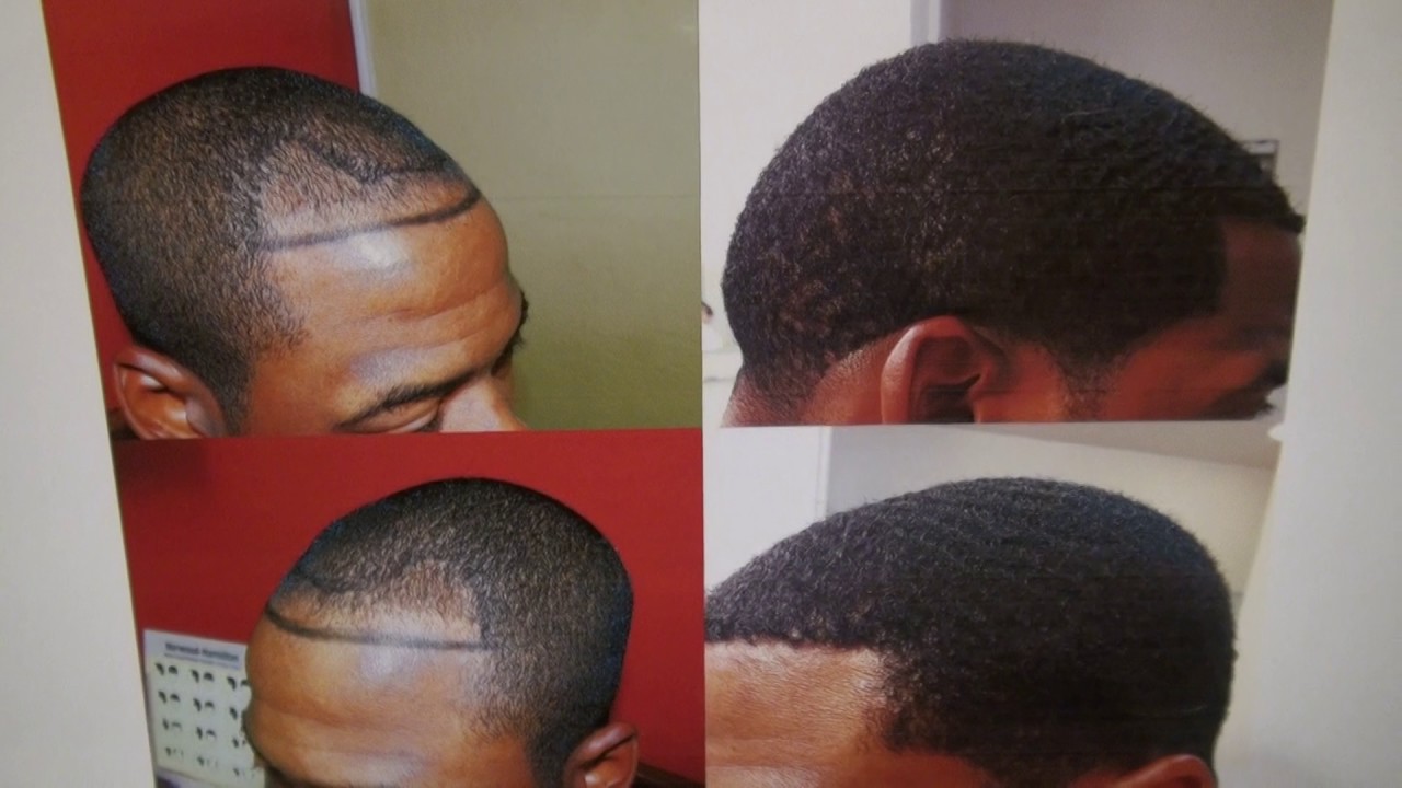 Dr. Diep Black Hairline Edges FUE Hair Transplant Surgery Follicular