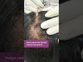 Hair PRP - Your natural solution to hair loss by Dr. Abin Basu I Dr. Vohra's Skin Clinic