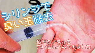 極細シリンジで臭い玉除去【膿栓洗浄】