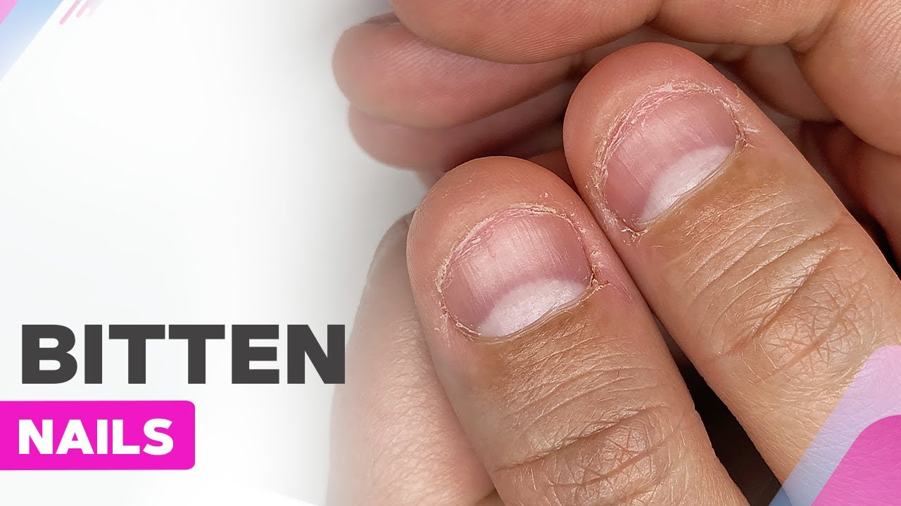 Man Nail Damage. Bitten Nails. Man Manicure. Nail Plate Problems. Man Hands  . Isolated on a White Background. Stock Photo - Image of holding,  infection: 178533826