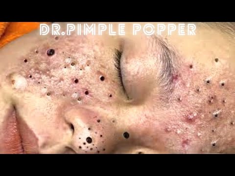 Treatment of Blackheads and Hidden Acne | dr pimple popper blackhead