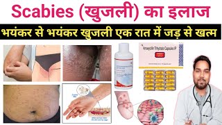 खुजली का इलाज क्या है | Scabies causes and symptoms | Scabies treatment in Hindi |  #scabies screenshot 5