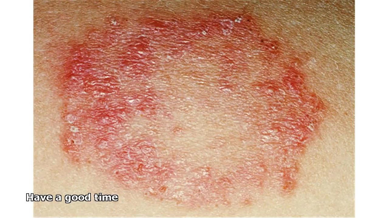 Fungal Infection Rash Youtube