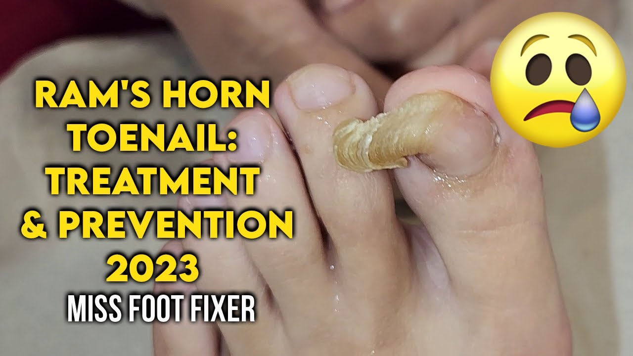 Ram's Horn Toenail Causes, Treatment, and Prevention Tips By Foot