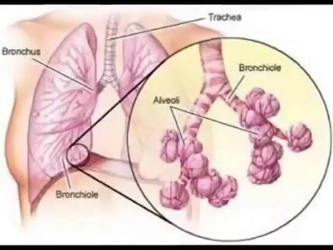 lung cancer and mesothelioma - All The Best Mesothelioma Law Firm ...