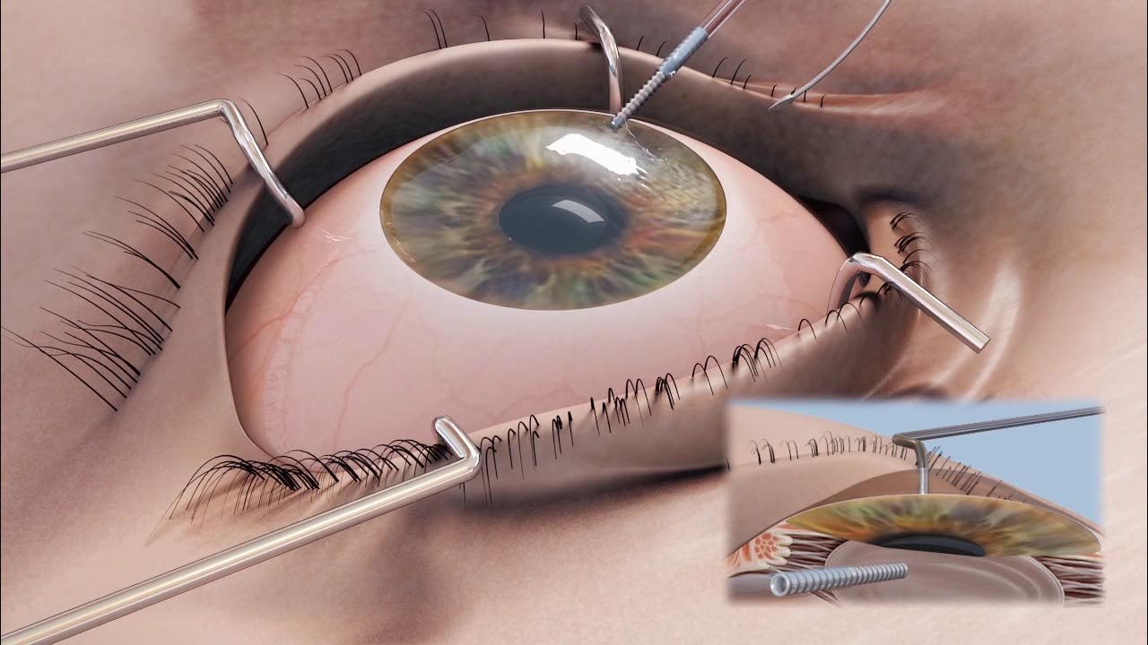 Corneal & Trephines Cornea Graft Transplant Surgical Procedure
