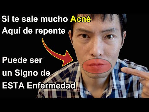 Si tienes <strong>mucho</strong> Acné aquí de repente, puede ser un signo de ESTA Enfermedad