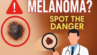 MELANOMA explained! causes and prevention methods #viral #healthylifestyle #fyp #melanoma #medicine