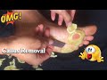 Callus Removal From Feet - 足からのカルス除去＃79