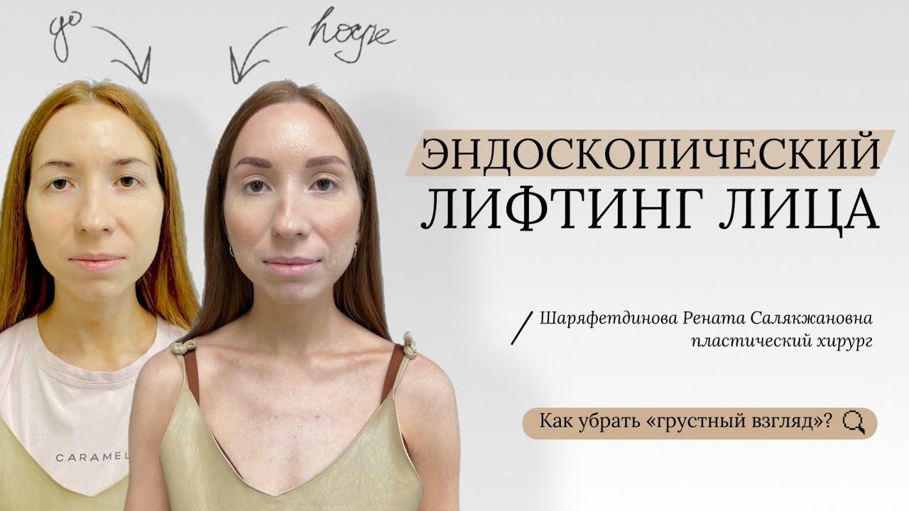 Эндоскопический лифтинг лица. Пластический хирург Шаряфетдинова Рената ...