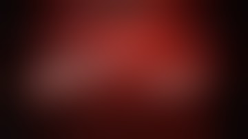 Large Complex Robotic Hernia Repair with Separation of Components: da Vinci assisted