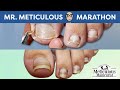 👣Impacted Toenail Gunk Removal on Mr. Meticulous👣 #MrMeticulousMarathon