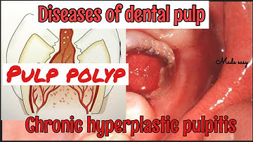 CHRONIC HYPERPLASTIC PULPITIS II PULP POLYP II DISEASES OF PULP II SERIES PART 4 II made easy