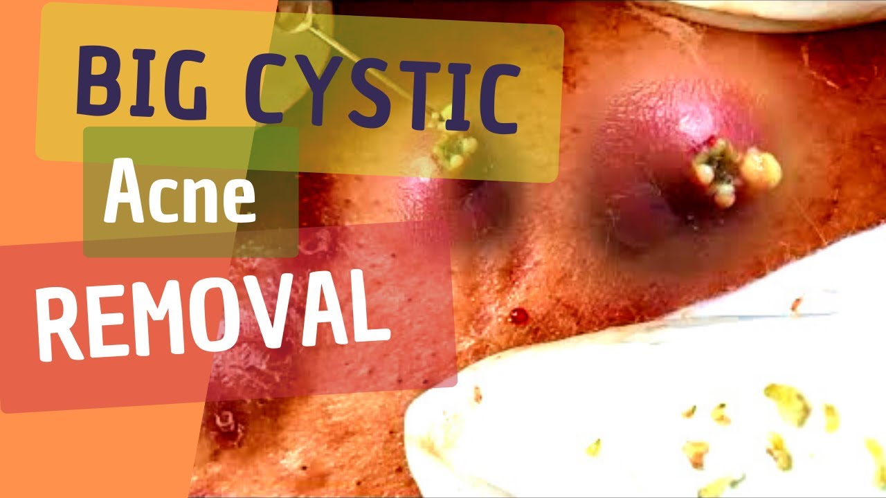 View of Big Cystic Acne and Blackheads Extraction - YouTube