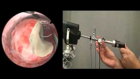 Handle Resectoscope in Hysteroscopy