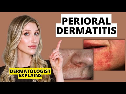 Video: Ce este dermatita berloque?
