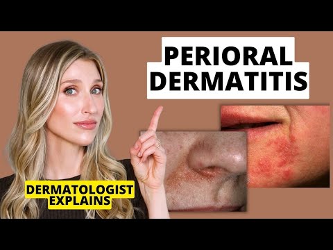 Video: Hva er berloque dermatitt?