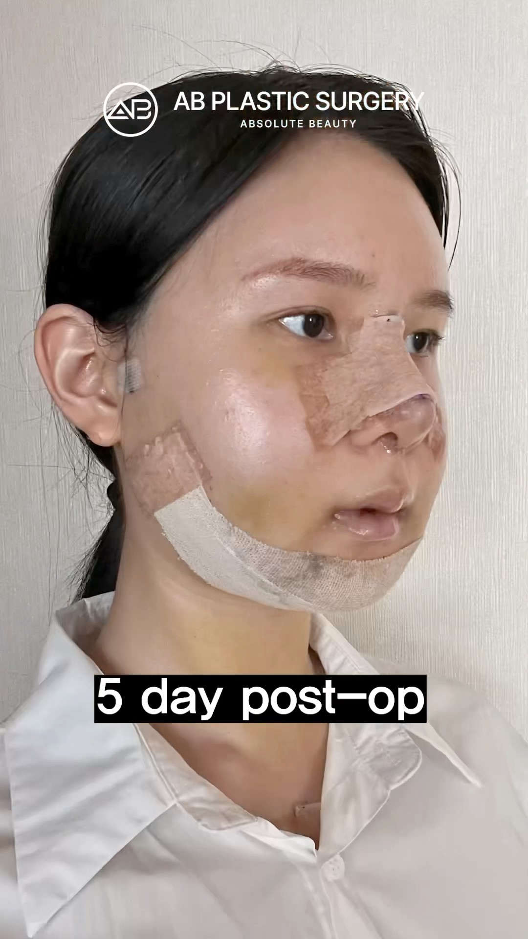 Before & After Facial Contouring, Jawline Transformation! #koreanplasticsurgery