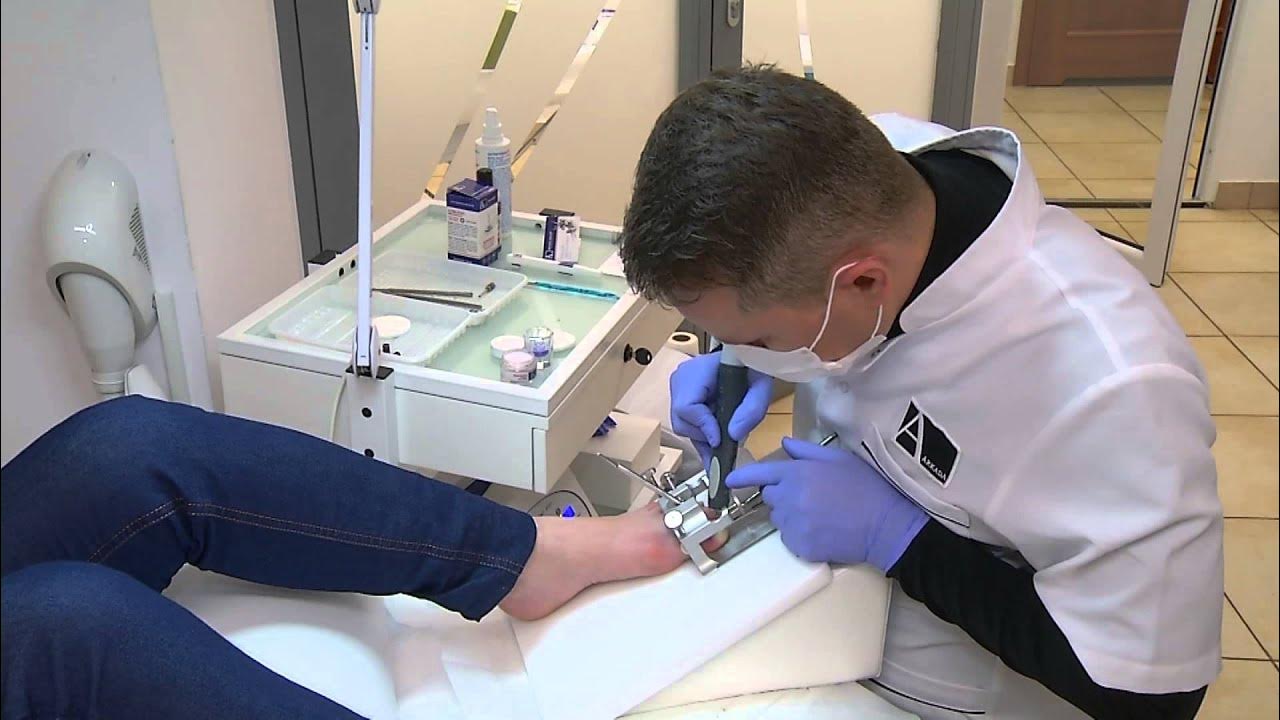 Podoexpert Lesson1 Twisted Big Toenail YouTube