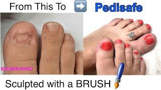 Are People STARING at Your UGLY Toes? Pedisafe Kit W/ Anti Fungal Properties Makes Toes Beautiful !