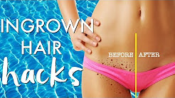 INGROWN HAIR HACKS | GET RID of INGROWN HAIRS | Paris & Roxy