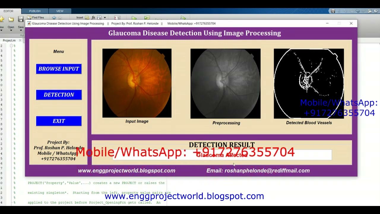 Glaucoma Detection Using Image Processing Matlab Project Source Code