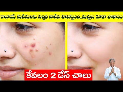 Pimples Removal On Face at Home | Thyme Oil Benefits | Dr Manthena Satyanarayana Raju Videos