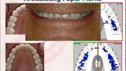 T-Scan Bite Force Dynamics