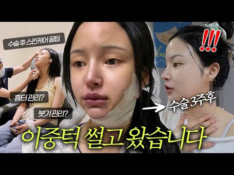 성형수술하고 집콕 브이로그🔥이중턱 썰고온 후기&amp;관리비법✨ 