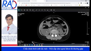 Chẩn đoán hình ảnh tắc ruột - Một cấp cứu ngoại khoa rất thường gặp