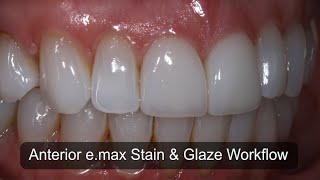 Anterior e.max Stain and Glaze Workflow for the CAD/CAM Dentists