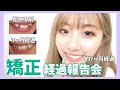 【歯列矯正】現在7ヶ月目！〜現状の歯の状態などお伝えします〜
