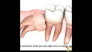 Types Of Impacted 3Rd Molar Wisdom Tooth Animated Video Of Impacted Wisdom Tooth