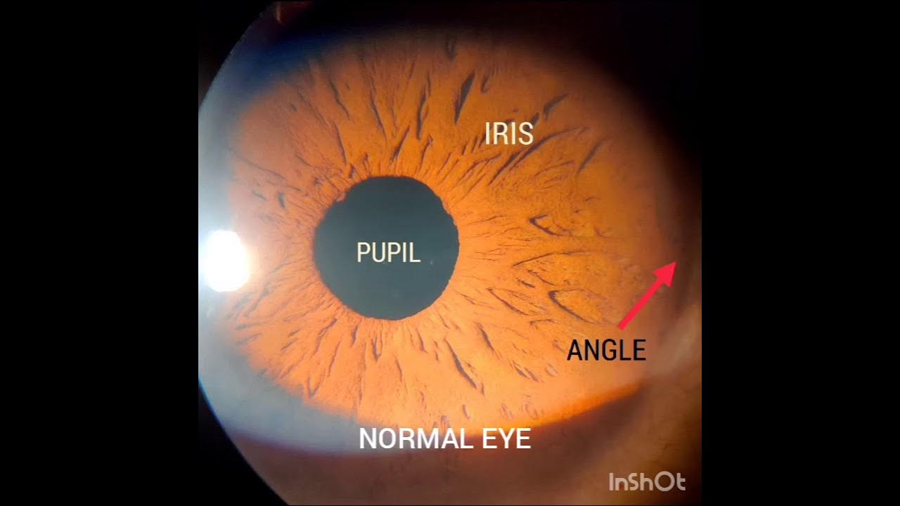 Laser Peripheral Iridotomy for Angle closure YouTube