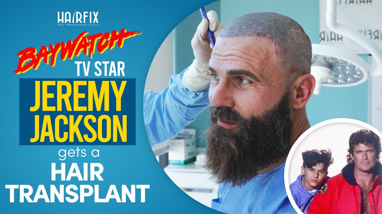From Hollywood Waves to Tijuana Wonders Jeremys Hair Transplant Experience  Hairfix Mxico