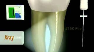 How to use endo file for Root canal treatment