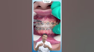 Cách Đeo Chun Liên Hàm Niềng Răng | Bác Sĩ Yên