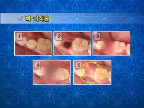 [라임나무치과병원]김인수 원장이 설명하는 뼈이식 임플란트