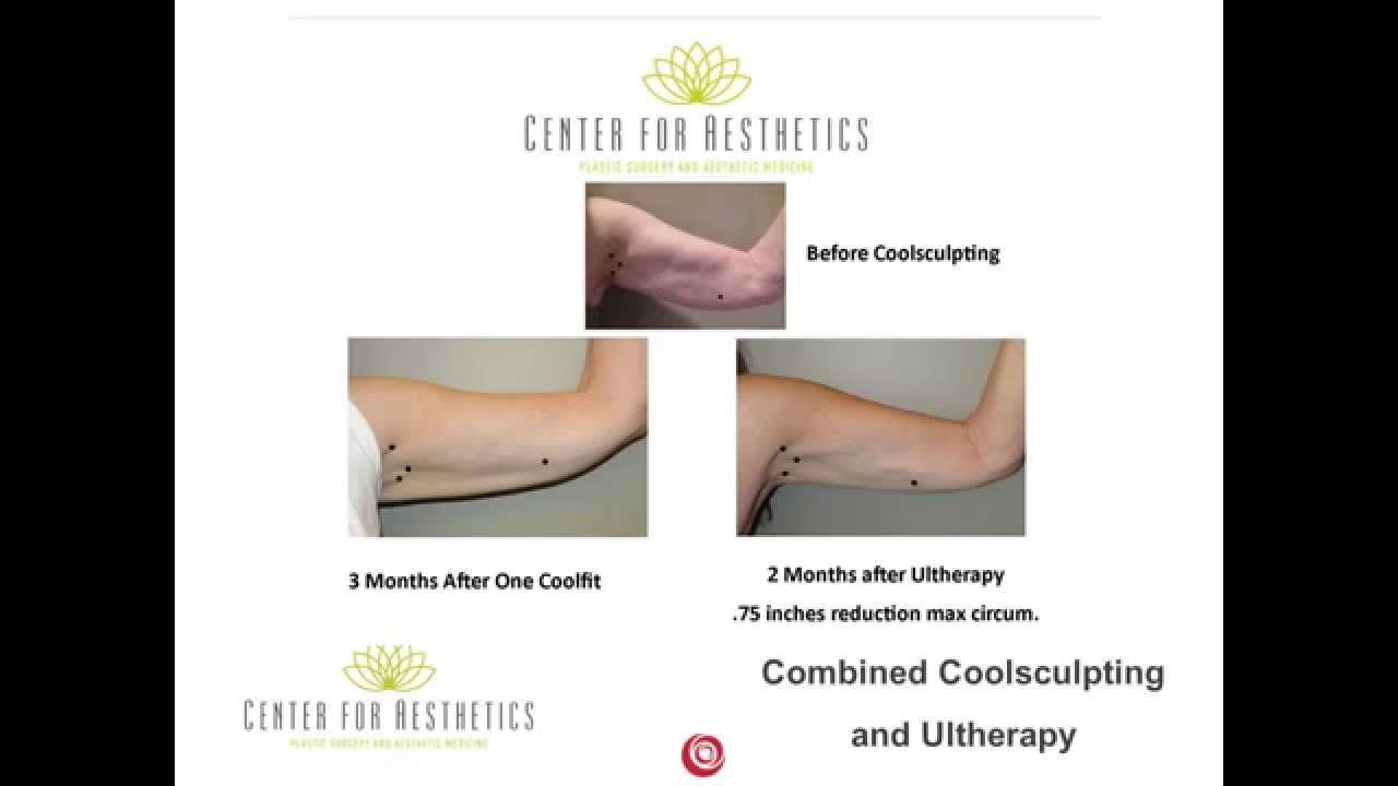 Bye Bye Batwings Coolsculpt and Ultherapy Arm Reduction YouTube